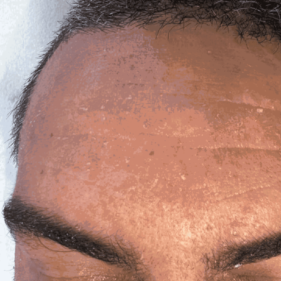 Peau avant le traitement Dr Platon